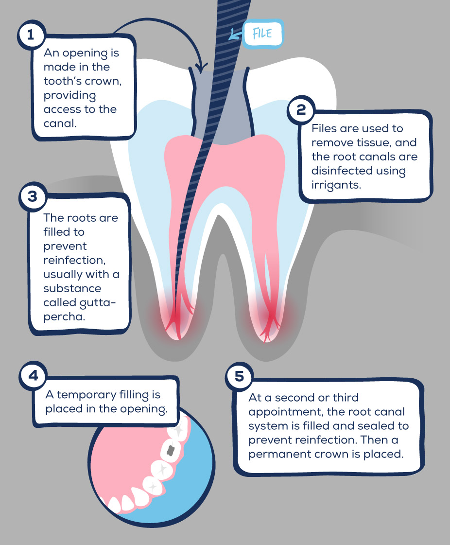 The Cost of a Dental Implant GentleWave Procedure